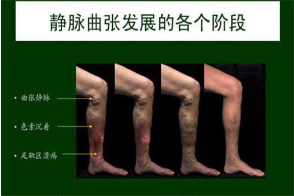 下肢静脉曲张六期症状图片是分哪些?